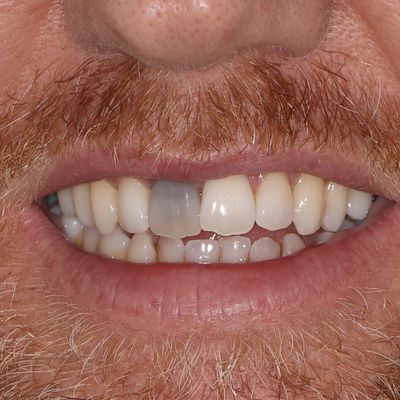 Dental Crown - Smile 1 before